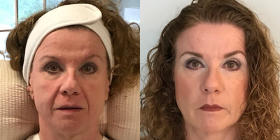 Thread Lift before and after photo