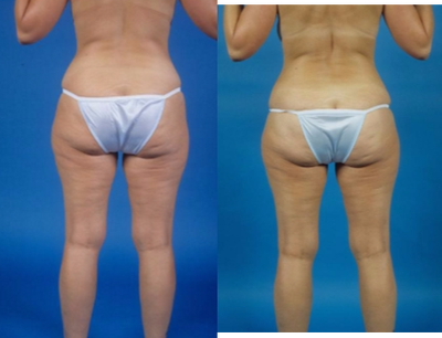 Tummy Tuck before and after photo