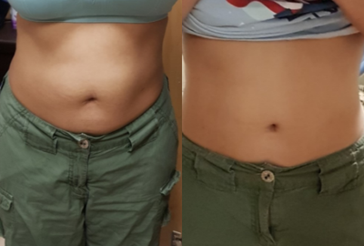 CoolSculpting before and after photo