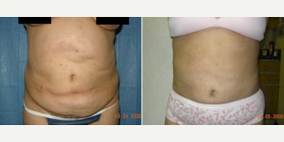 Tummy Tuck before and after photo