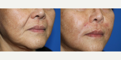 Bellafill before and after photo