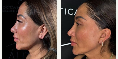 Brow Lift before and after photo