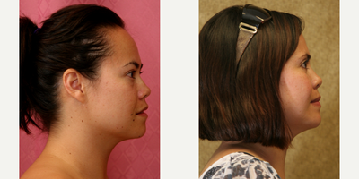 Eyelid Surgery before and after photo