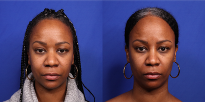 Restylane before and after photo