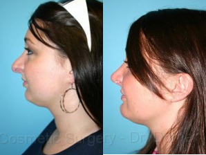 Rhinoplasty before and after photo