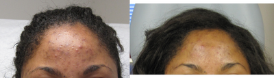 VI Peel before and after photo