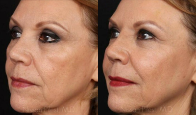 Botox before and after photo