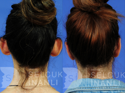Ear Surgery before and after photo