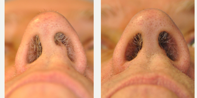 Septoplasty before and after photo