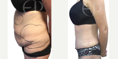 Tummy Tuck before and after photo