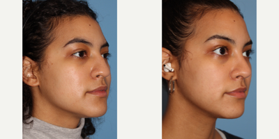 African American Rhinoplasty before and after photo