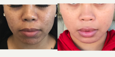 Chemical Peel before and after photo