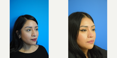 Chin Implant before and after photo