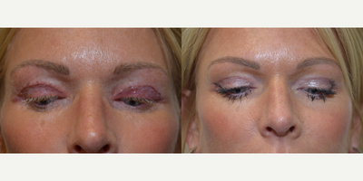Eyelid Surgery before and after photo