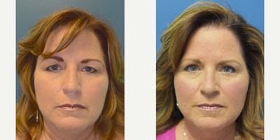 Eyelid Surgery before and after photo