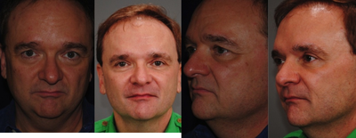Botox before and after photo