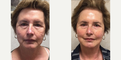 Bellafill before and after photo