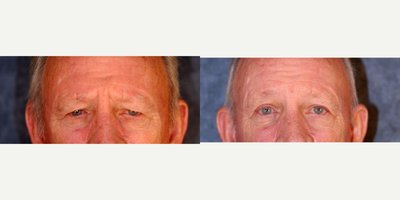 Eyelid Surgery before and after photo