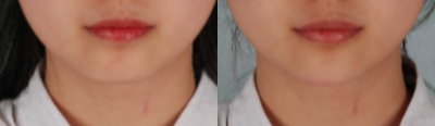 Juvederm before and after photo