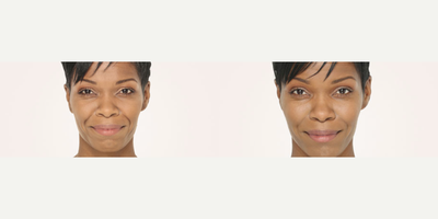 Radiesse before and after photo