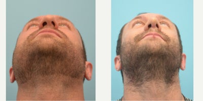 Rhinoplasty before and after photo