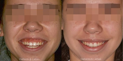 Smile Makeover before and after photo