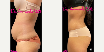 Tummy Tuck before and after photo