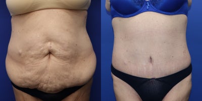 Tummy Tuck before and after photo