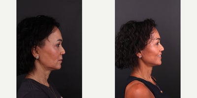 Deep Plane Facelift before and after photo