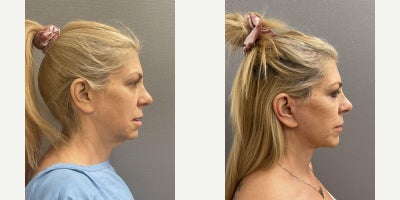 Eyelid Surgery before and after photo