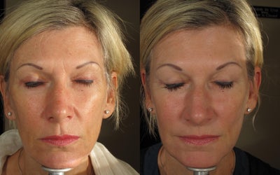 Juvederm before and after photo