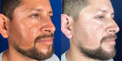 Chemical Peel before and after photo