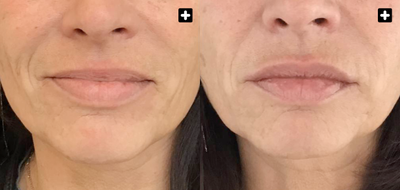 Dermal Fillers before and after photo