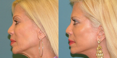 Facelift before and after photo