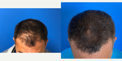 FUE Hair Transplant before and after photo