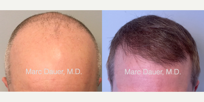 FUE Hair Transplant before and after photo