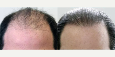 Hair Transplant before and after photo