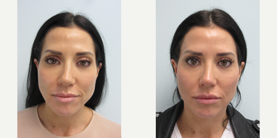 Liquid Facelift before and after photo