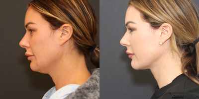 Neck Lift before and after photo