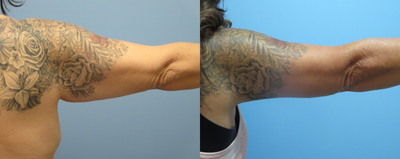 Arm Lift before and after photo