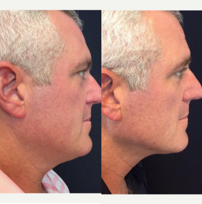 CoolSculpting before and after photo