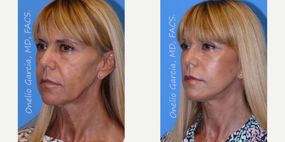 Facelift before and after photo