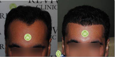 FUE Hair Transplant before and after photo