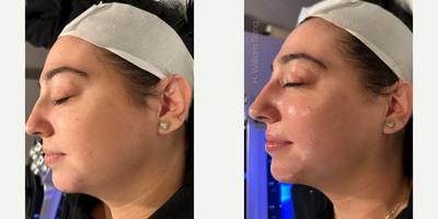 HydraFacial before and after photo