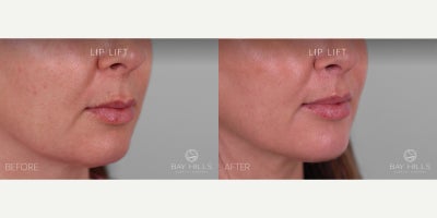 Lip Lift before and after photo