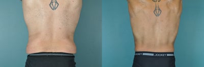 Body Lift before and after photo
