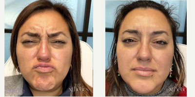Botox before and after photo