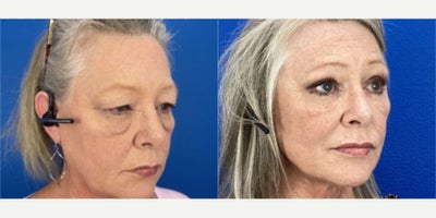 Brow Lift before and after photo