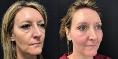 Chemical Peel before and after photo