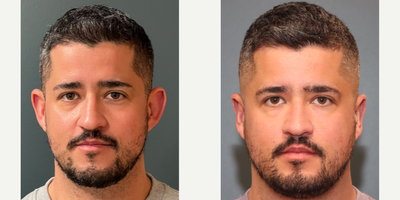Ear Surgery before and after photo